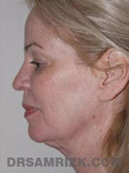Female patient Preoperative Facelift procedure - side view