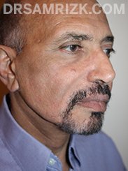 Female patient Postoperative Facelift procedure - side view