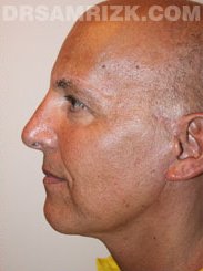 male patient after Facelift