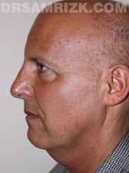 male before Facelift - picture