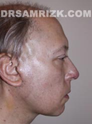 Facelift after photo Male