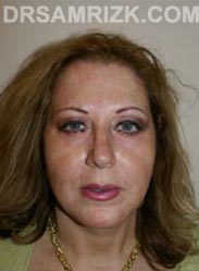 Facelift patient after - picture