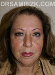 Female Facelift procedure before - pictures