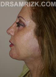 Female Facelift procedure after - side view