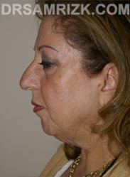 women Facelift procedure before - image