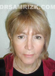 Facelift procedure after photo female patient