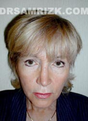 Facelift procedure before photo female patient