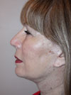 Facelift New York