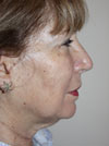 Facelift New York