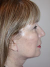 Facelift New York