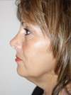 Facelift New York