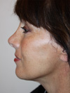 Facelift New York