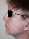 Facelift New York