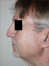 Facelift New York