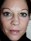 Nose Job NYC