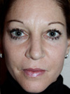Nose Job NYC