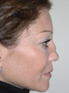 Nose Job NYC