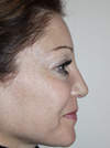 Nose Job NYC