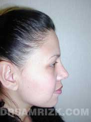 image female after rhinoplasty - side view
