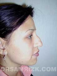 nose surgery photography before