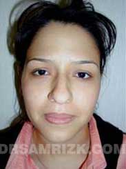 Female before Nose Surgery - pic