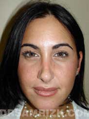image Female after Nose Surgery
