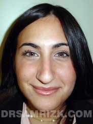Female before Nose Surgery - photo