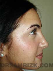 picture Female after Nose Surgery