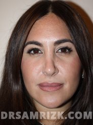 picture Female after Nose Surgery