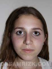 Female after Nose Surgery - pic