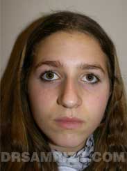 Female before Nose Surgery - image