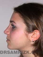 Female after Nose Surgery - image
