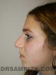Female before Endoscopic (Endonasal) Rhinoplasty
