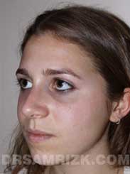 Female after Nose Surgery - photo