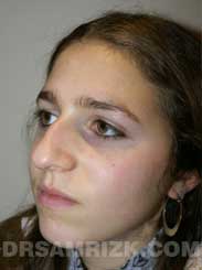 pic Female patient before Nose Surgery