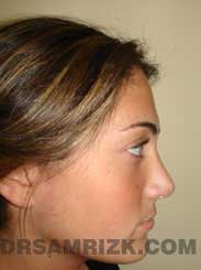 photo Female patient after Nose Surgery