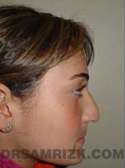 Female before Nose Surgery - picture