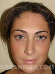 pic Female patient after Nose Surgery