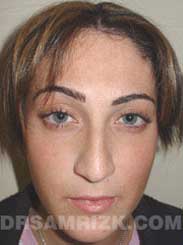 picture Female patient before Nose Surgery