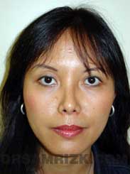 photo Asian Female patient after Nose Surgery