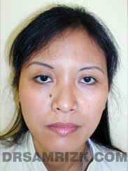 Female patient before Nose Surgery