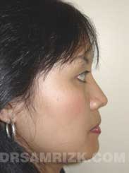 picture Female patient after Nose Surgery