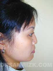 photo Asian Female patient before Nose Surgery