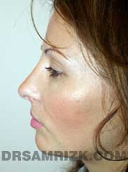 Female patient after Nose Surgery