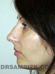 Female patient before Nose Surgery - photo