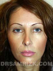 Female patient after Nose Job - photo