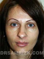 Female patient before Nose Job - image