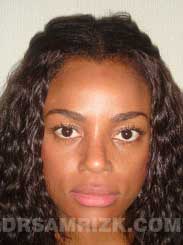 Female patient after Nose Job - pic