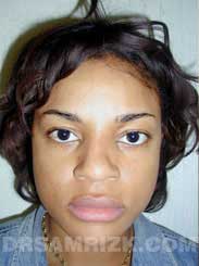 Female patient before Nose Surgery - pic
