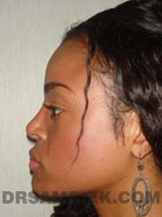 Female patient after Nose Surgery - image
